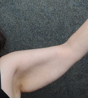 Arm Lift
