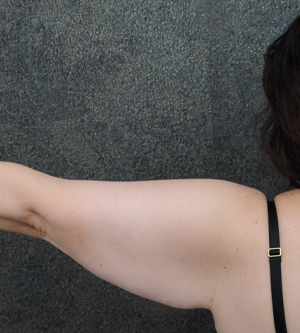 Arm Lift
