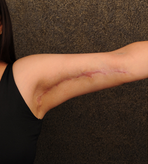 Arm Lift