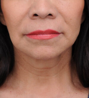 Lip Lift