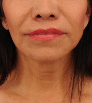 Lip Lift