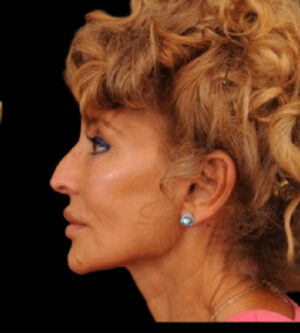 Facelift