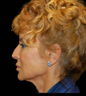 Facelift