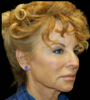 Facelift