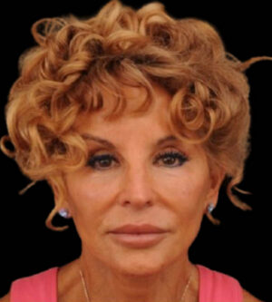 Facelift