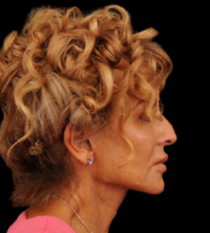 Facelift
