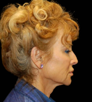Facelift