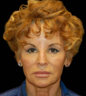Facelift