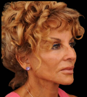 Facelift