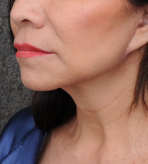 Facelift