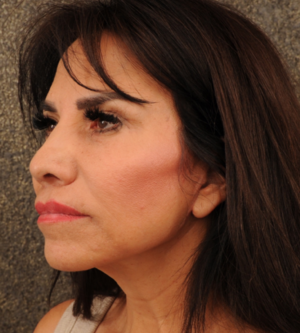 Facelift