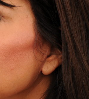 Facelift