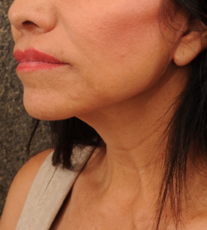 Facelift
