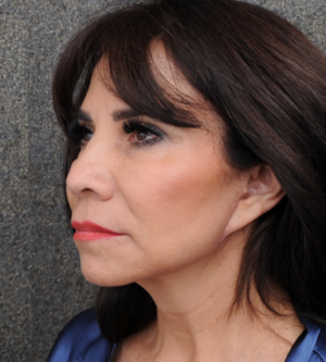 Facelift
