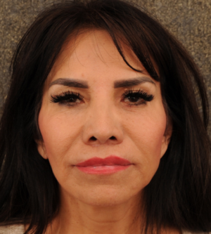 Facelift
