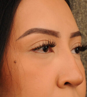 Eyelid Surgery