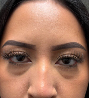 Eyelid Surgery