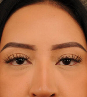 Eyelid Surgery