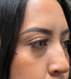 Eyelid Surgery