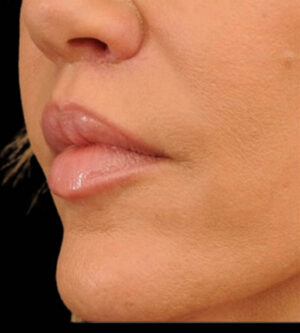 Lip Lift