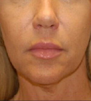 Lip Lift