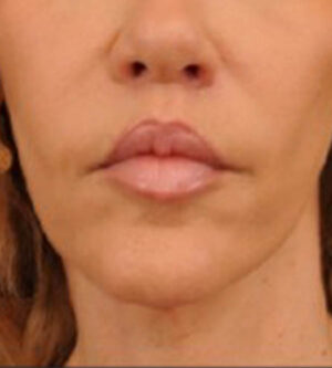 Lip Lift
