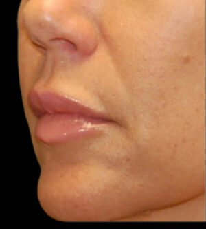 Lip Lift