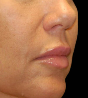 Lip Lift