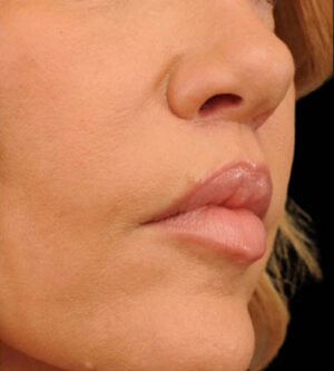 Lip Lift