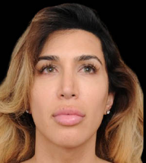 Facial Feminization Surgery (FFS)