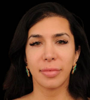 Facial Feminization Surgery (FFS)