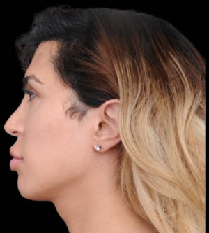 Facial Feminization Surgery (FFS)
