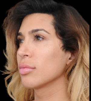 Facial Feminization Surgery (FFS)