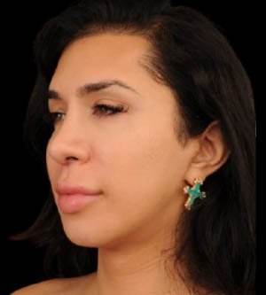 Facial Feminization Surgery (FFS)