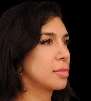 Facial Feminization Surgery (FFS)