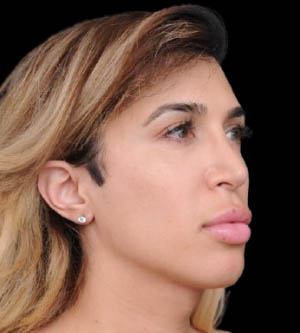 Facial Feminization Surgery (FFS)