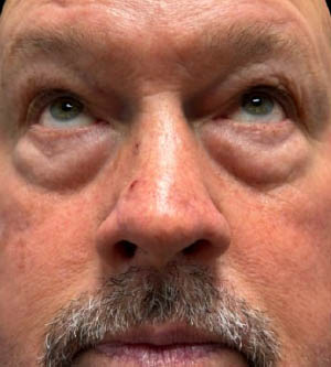 Eyelid Surgery
