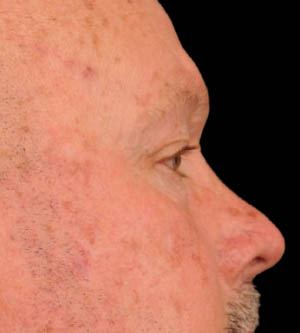 Eyelid Surgery