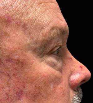 Eyelid Surgery