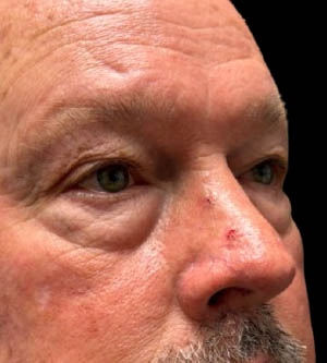 Eyelid Surgery