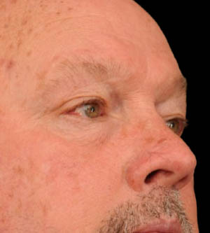 Eyelid Surgery