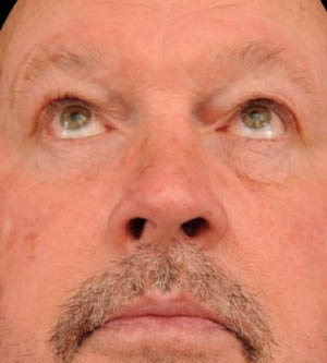 Eyelid Surgery