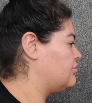 Neck Lift