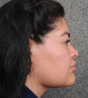 Neck Lift