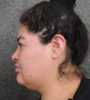 Neck Lift