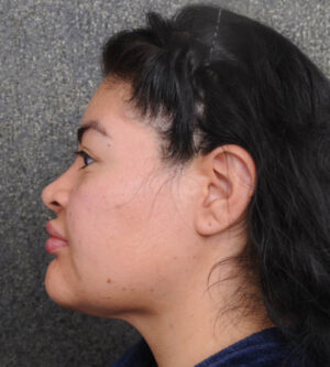 Neck Lift