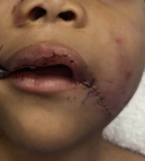 Pediatric Reconstruction