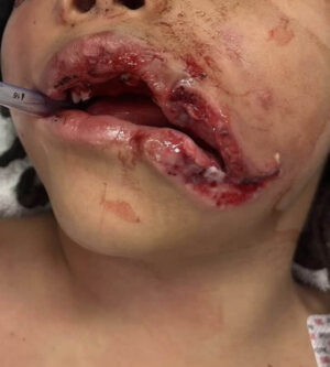 Pediatric Reconstruction