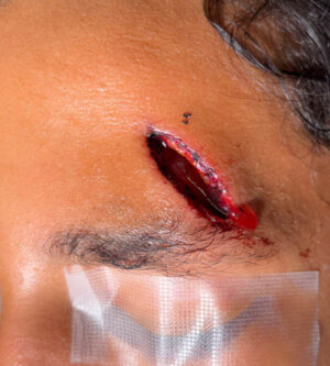 Pediatric Reconstruction