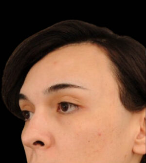 Facial Feminization Surgery (FFS)